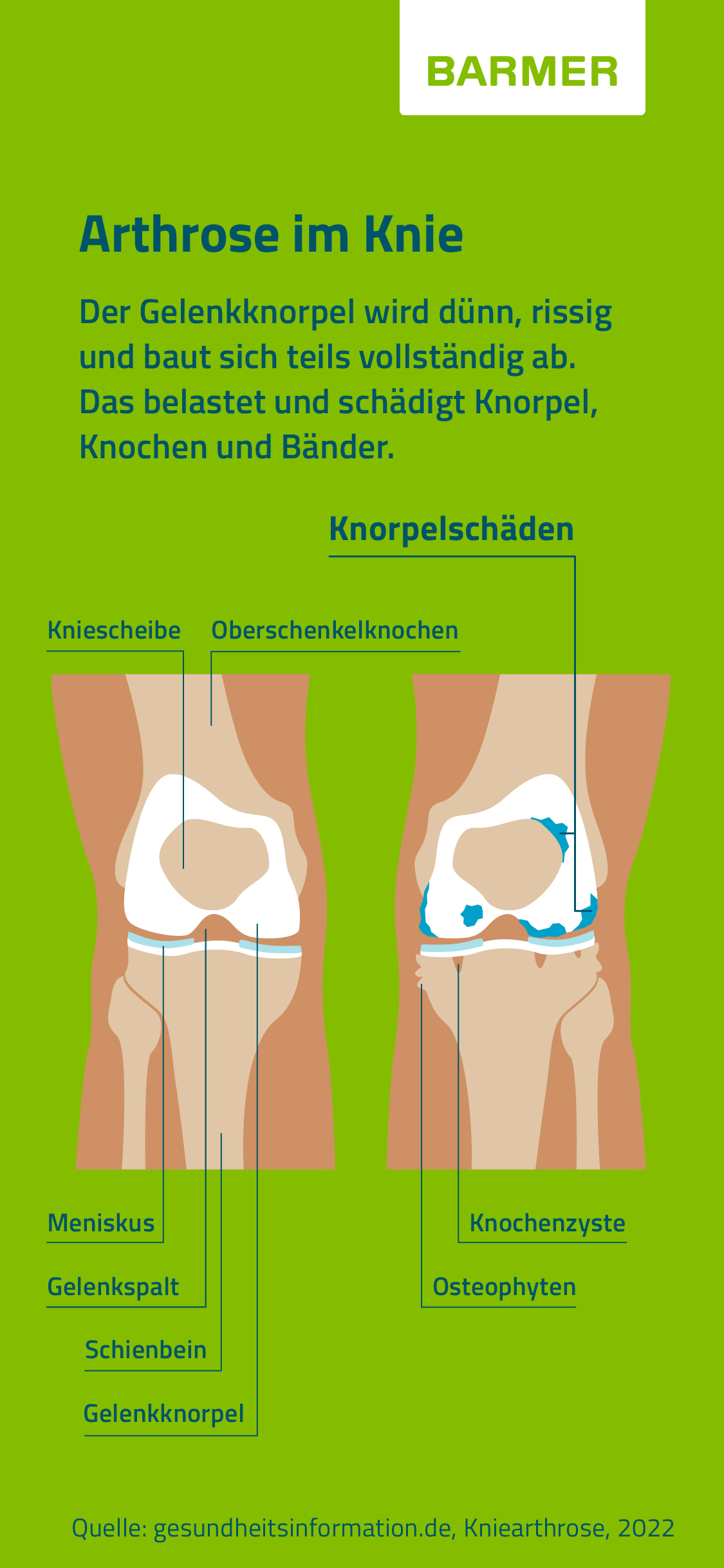 Zu sehen ist die Grafik "Arthrose im Knie: gesundes vs. erkranktes Kniegelenk"